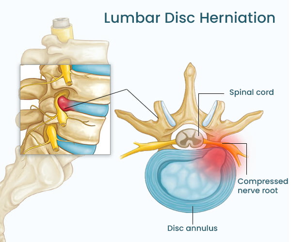 looking for lumbar disc specialists in boucherville? our experienced team offers advanced diagnosis and personalized treatment for back pain, herniated discs, and spinal issues. book an appointment today for expert care.