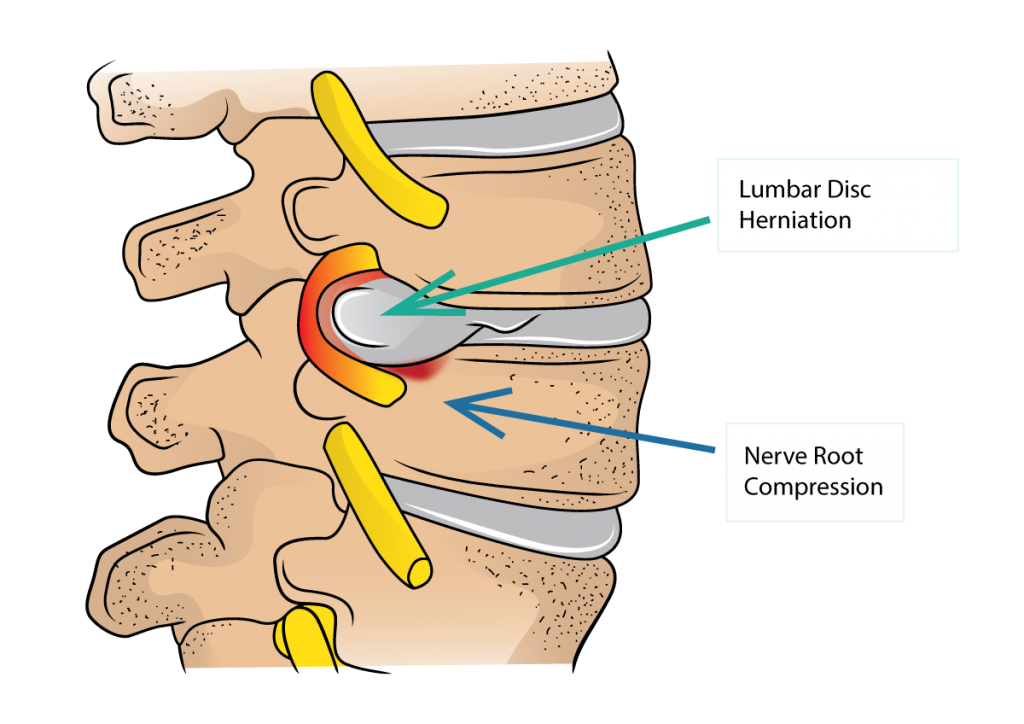 looking for lumbar disc specialists in boucherville? our expert team provides advanced diagnosis and personalized treatment for back pain and disc issues. regain comfort and mobility today.