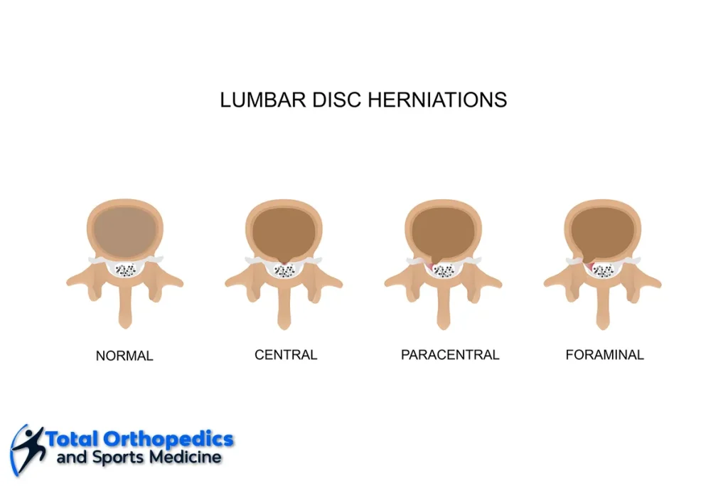 looking for lumbar disc specialists in boucherville? our experienced team offers expert diagnosis and advanced treatments for lumbar disc issues. get relief from back pain—book your consultation today!