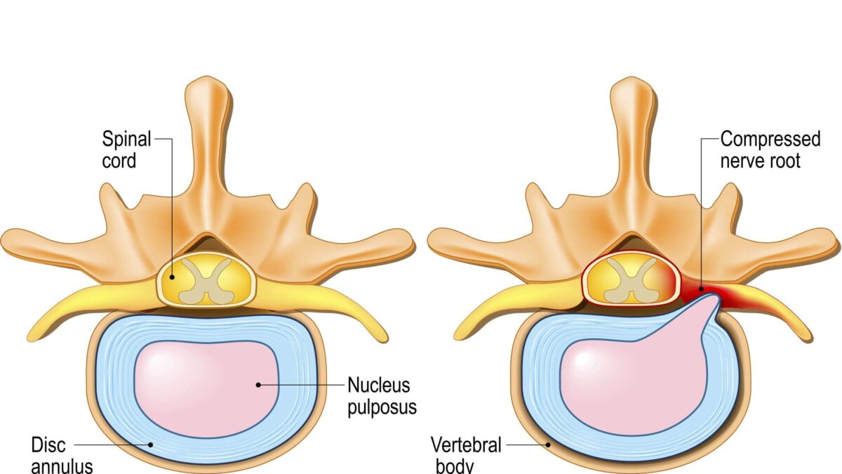 discover effective cervical disc herniation treatment options, including conservative therapies, medications, physical therapy, and surgical interventions to relieve neck pain and improve mobility.