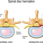 discover effective cervical disc herniation treatment options, including conservative therapies, medications, physical therapy, and surgical interventions to relieve neck pain and improve mobility.