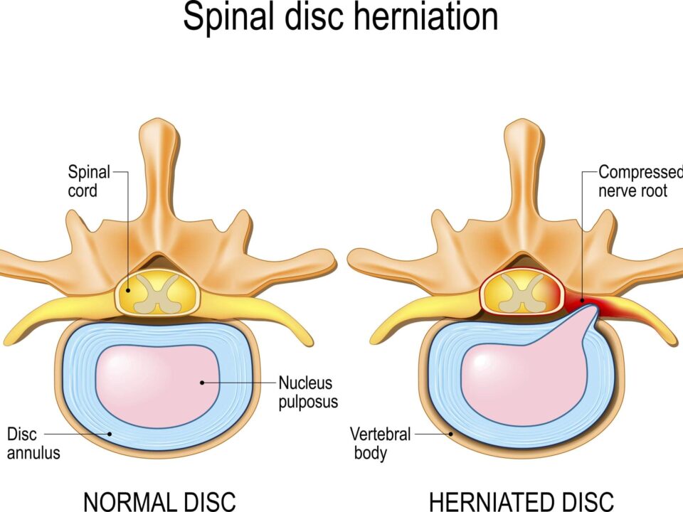 discover effective cervical disc herniation treatment options, including conservative therapies, medications, physical therapy, and surgical interventions to relieve neck pain and improve mobility.