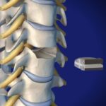 discover inspiring cervical disc recovery stories from real people. learn about their challenges, treatments, and journeys to better spinal health.