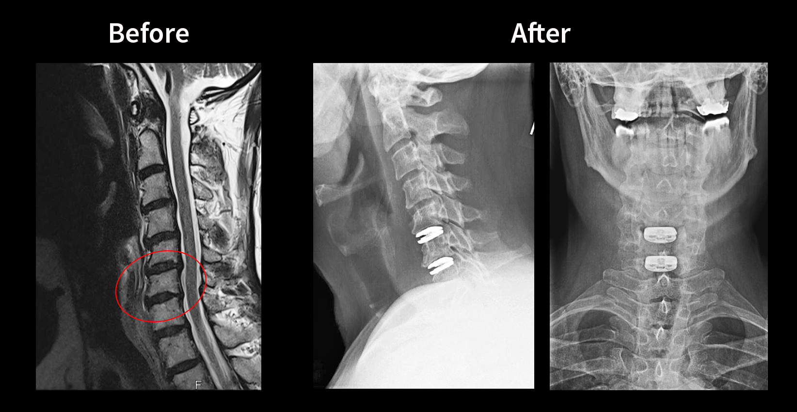 discover inspiring cervical disc recovery stories from real people who overcame spinal issues, detailing their challenges, treatments, and journeys back to a pain-free life.