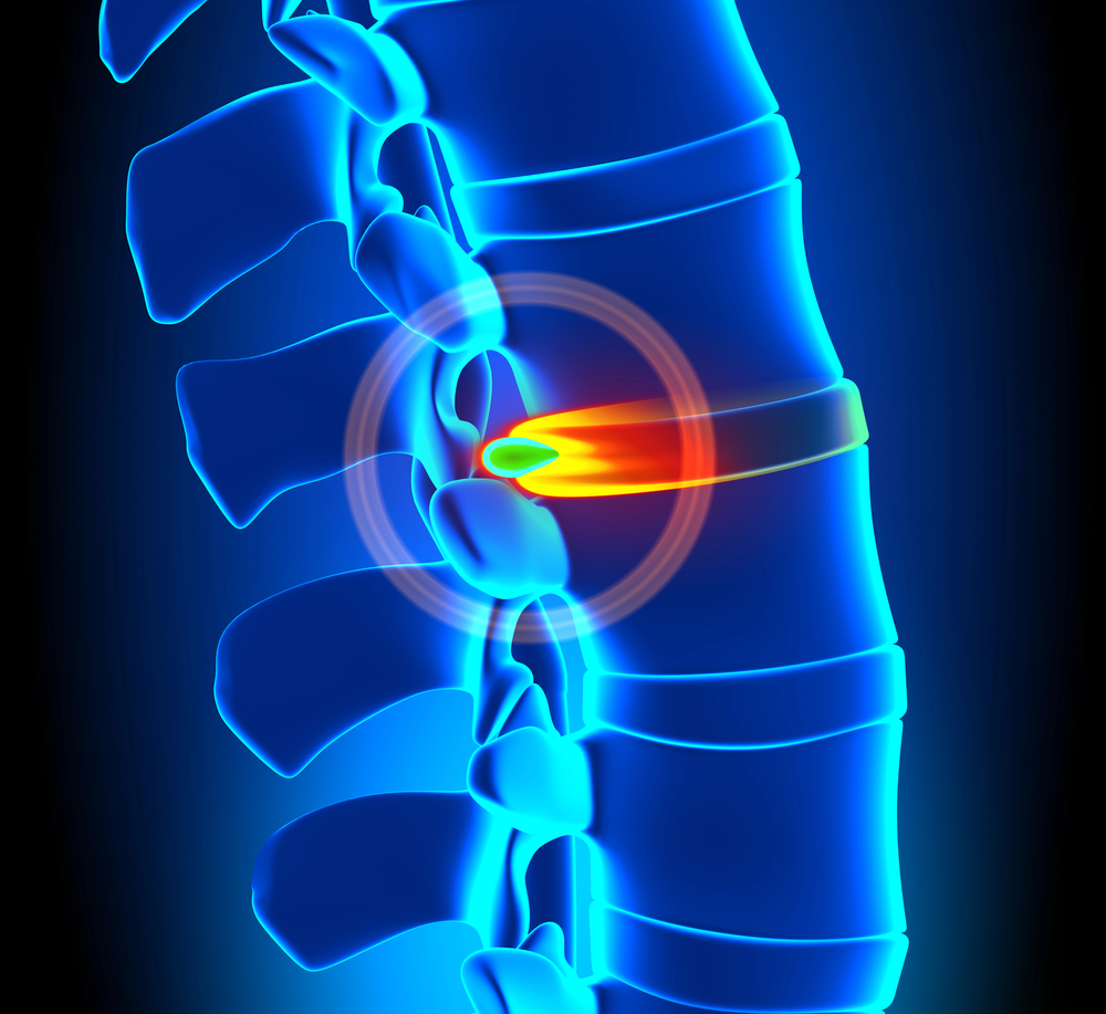 discover the herniation recovery timeline in repentigny. learn what to expect during each stage of recovery, tips for healing fast, and how to regain strength safely.