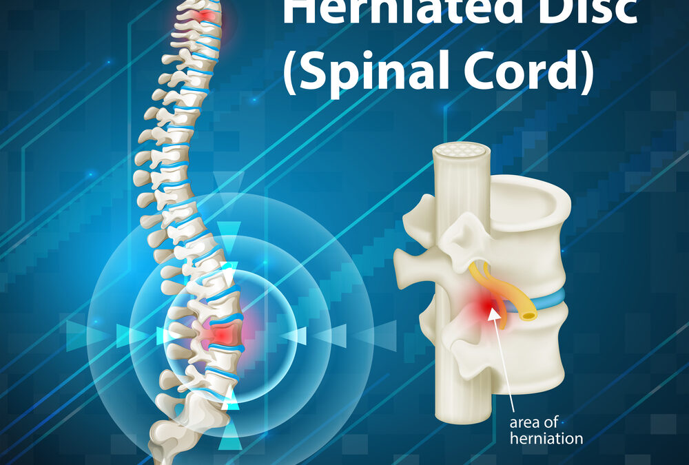 discover the hernia recovery timeline in repentigny. learn about typical healing stages, what to expect after surgery, and tips for a smooth recovery process.