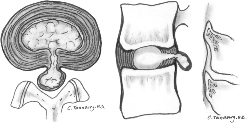 discover the herniation recovery timeline for patients in repentigny, including key stages, tips for faster healing, and what to expect during your rehabilitation process.