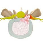 discover expert tips and treatments for hernia disc prevention in longueuil at tagmed. protect your spine health with our personalized care and advanced therapies.