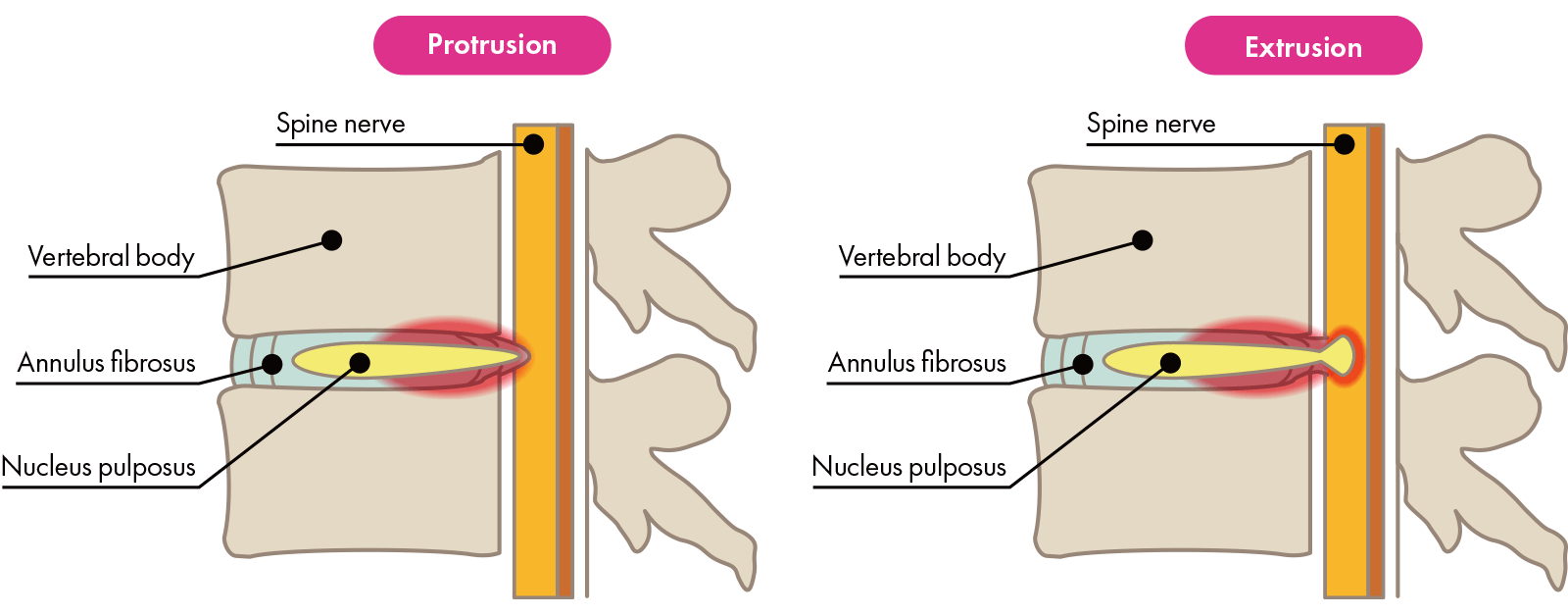 discover effective herniated disc prevention tips in longueuil with tagmed. learn how to protect your spine, reduce your risk, and maintain a healthy back with expert advice and care.