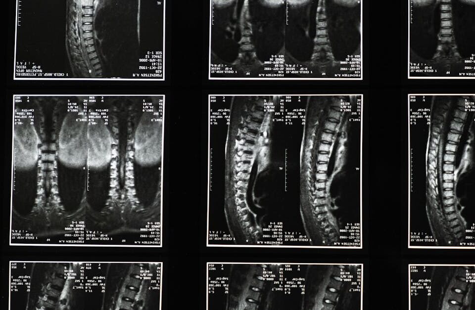 discover what lumbar decompression is, its benefits, procedures, and how it can help relieve lower back pain caused by spinal compression. learn about recovery and expected outcomes.