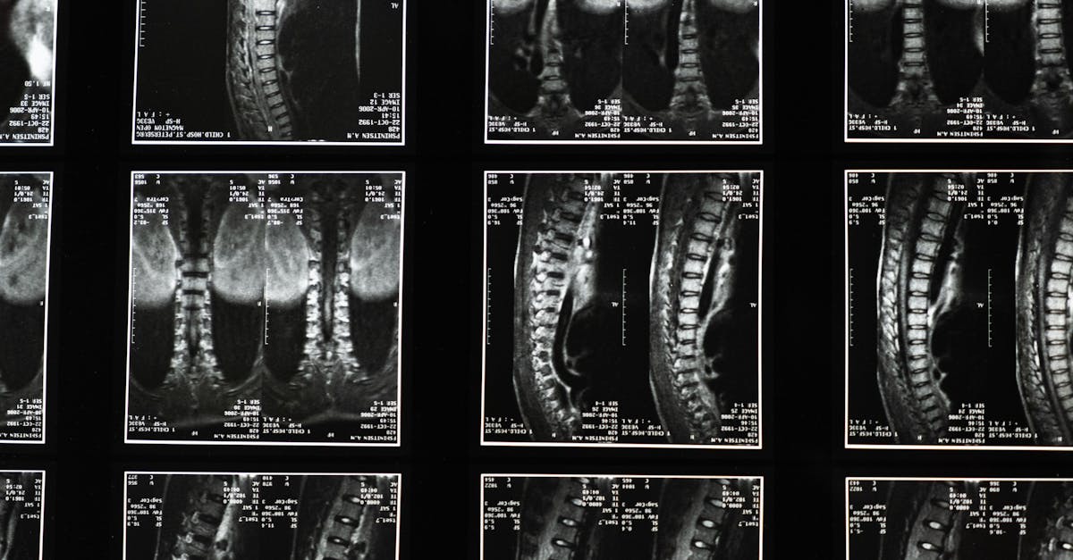learn about lumbar stenosis, its causes, symptoms, and treatment options. discover how this spinal condition can impact mobility and what steps you can take to manage pain and improve quality of life.