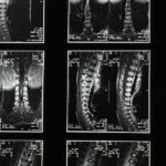 discover essential information about sciatica, including common causes, symptoms, and effective treatment options to relieve nerve pain and improve your quality of life.