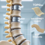 explore the pivotal role of innovative implants like tops™, intraspine®, and esp in enhancing medical outcomes, offering advanced solutions for spinal health and patient recovery.